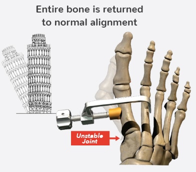 skeletal foot with bunion being corrected with metal device with knob