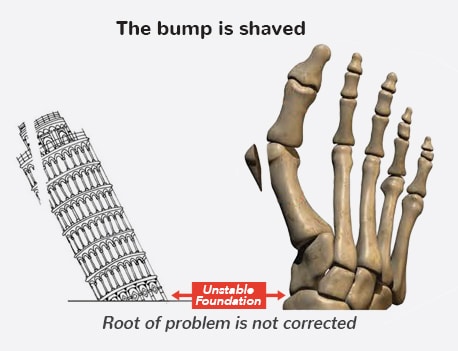 3D- rendered skeletal foot with bunion sticking out of left side compared to leaning tower of pisa
