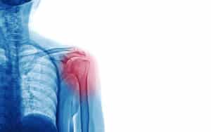 Shoulder Injury Treatment Highland IN