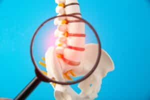 Magnified view of a model of the human lumbar spine used to illustrate spinal damage treated by vertebroplasty